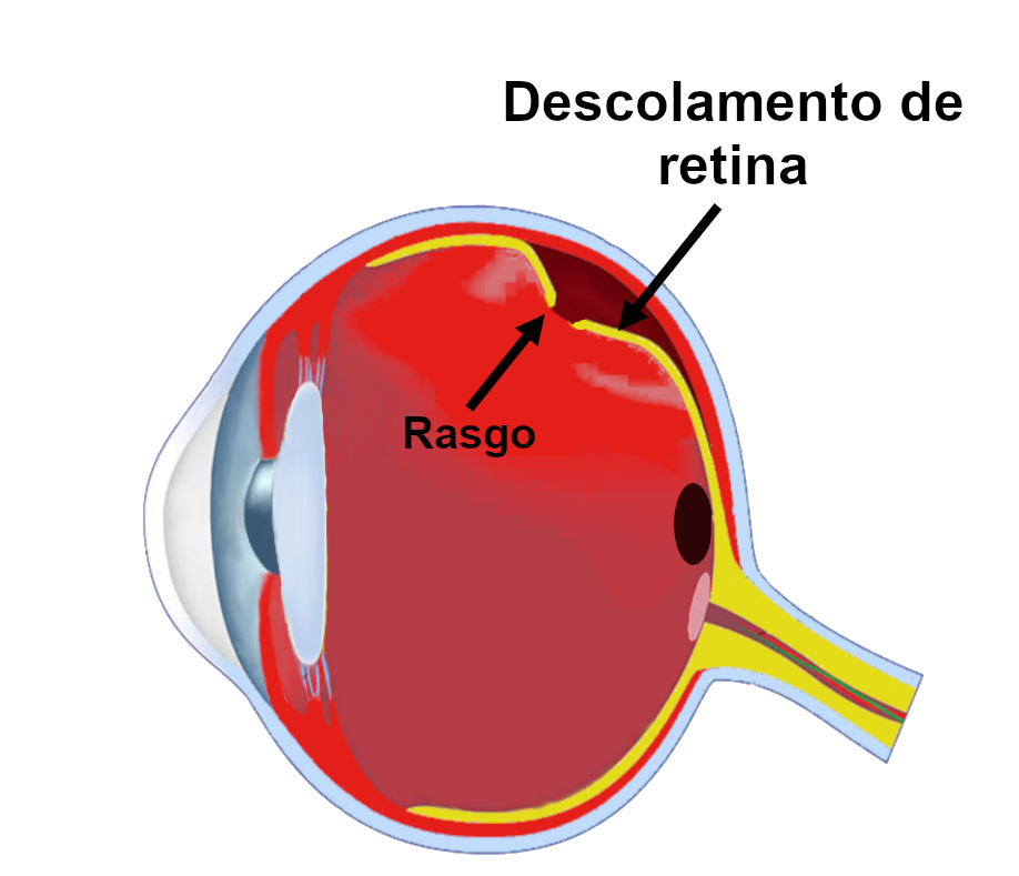 Cirurgia e Tratamento para Descolamento de Retina - COHR